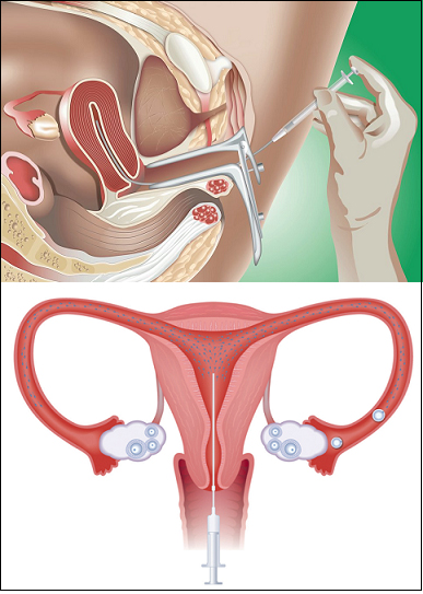 Intrauterine Insemination (IUI)