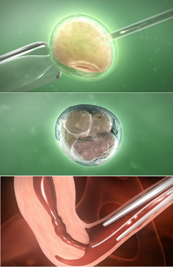 Intracytoplasmic sperm injection (ICSI)