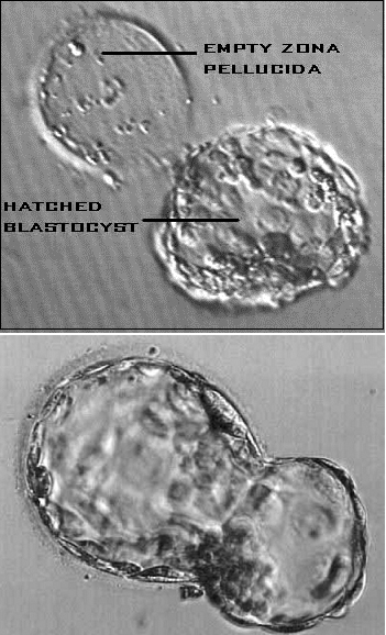 Laser Assisted Hatching